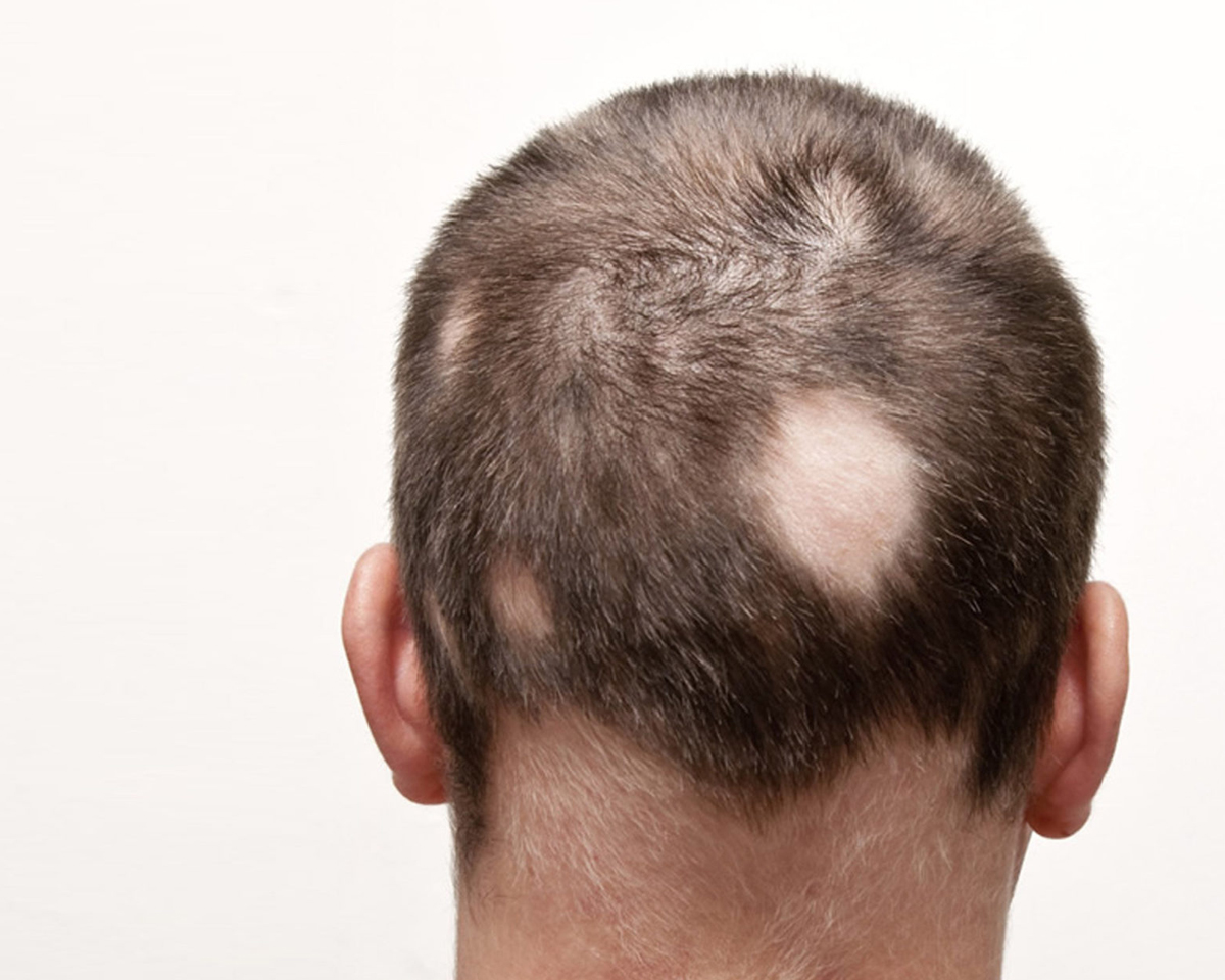 Alopecia Areata