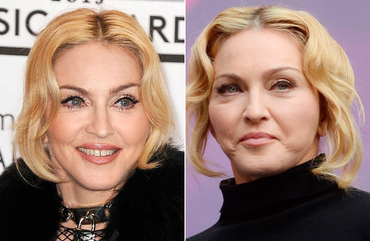 Botox: Mitos & Verdades