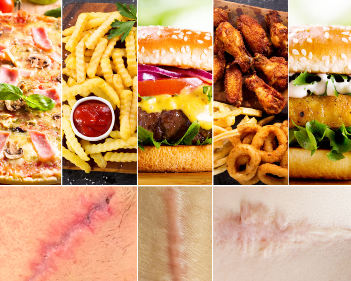 Cicatrices y Alimentación