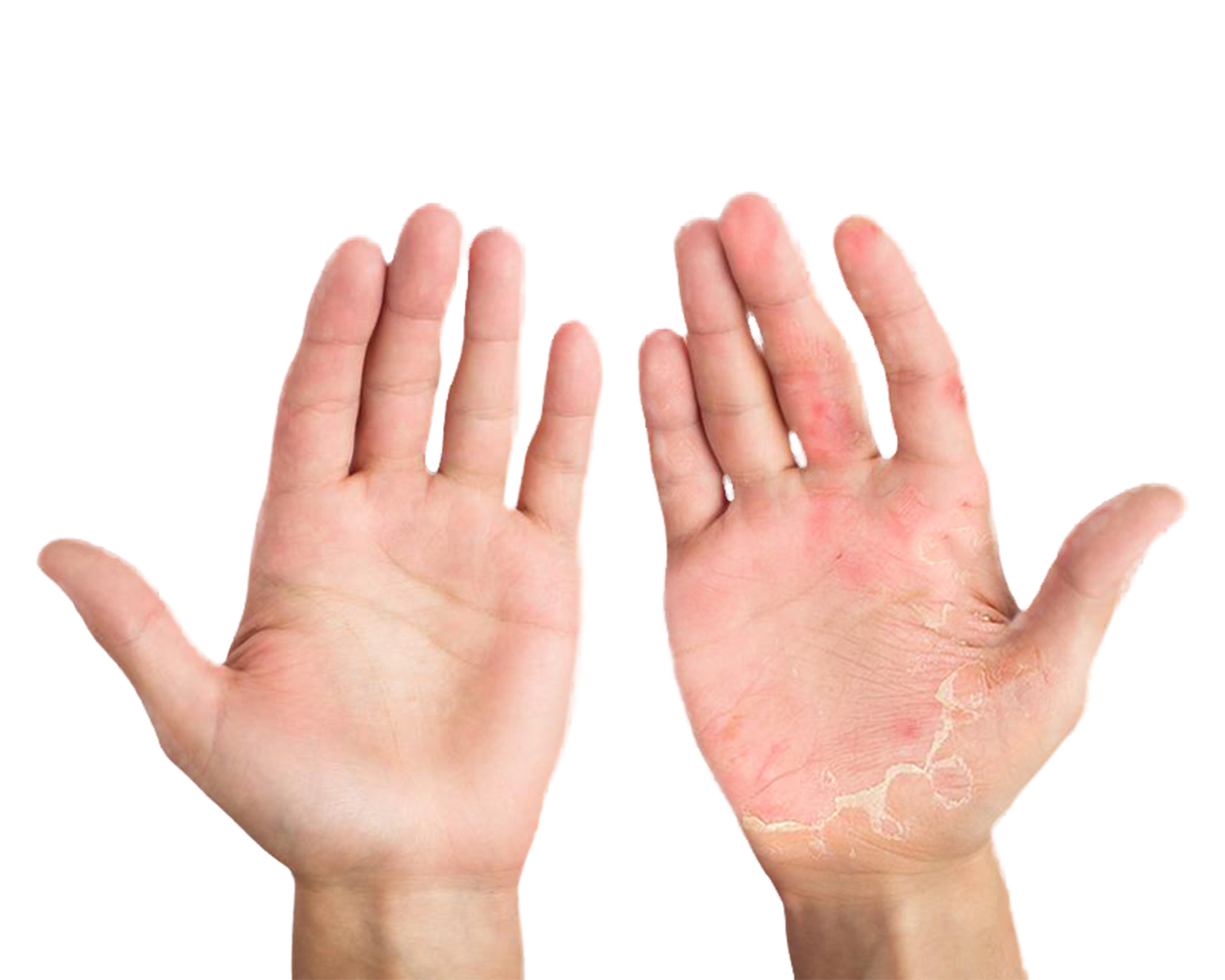 Dermatitis de contacto y COVID-19