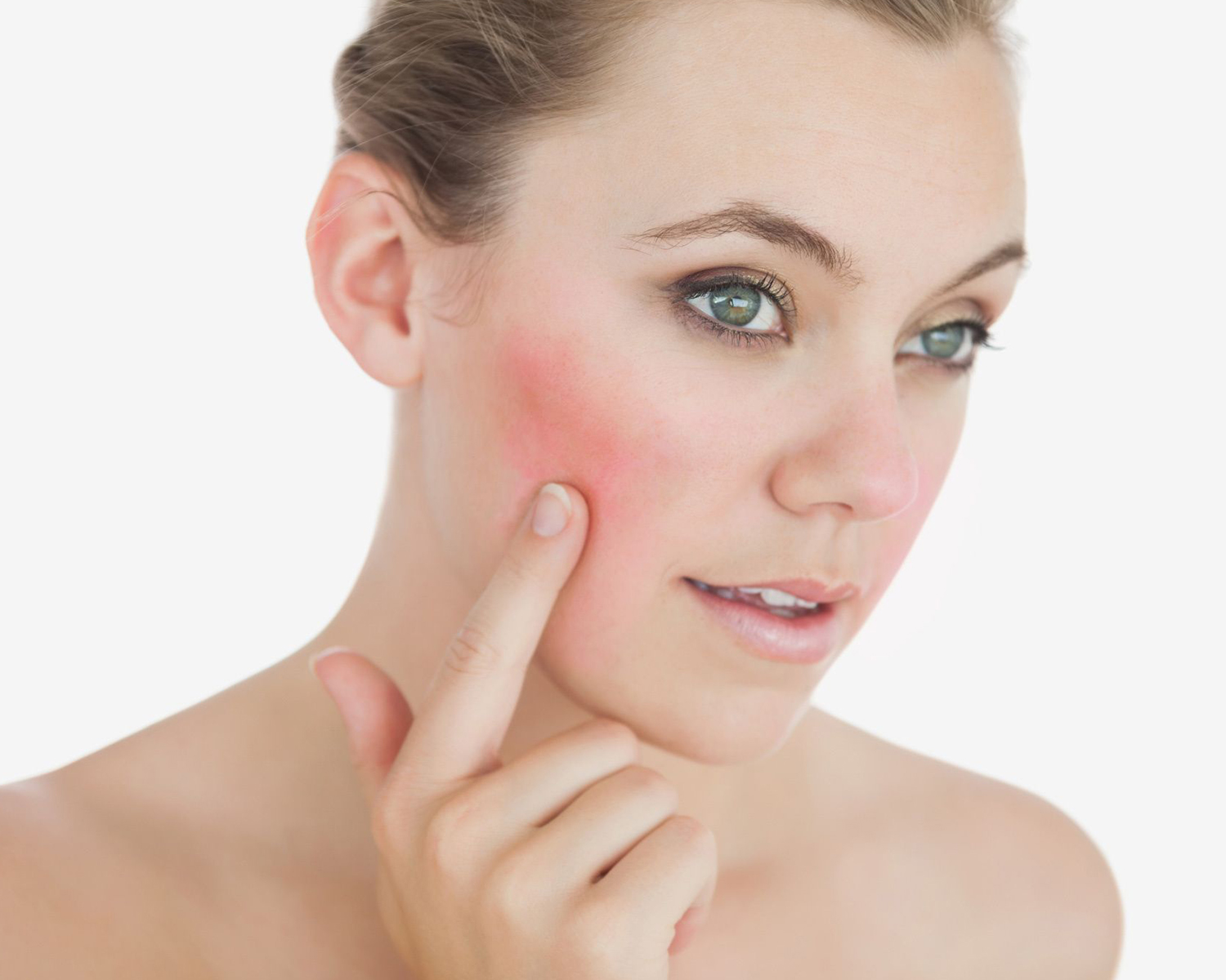 ¿Qué es la rosacea y cuáles son sus síntomas?