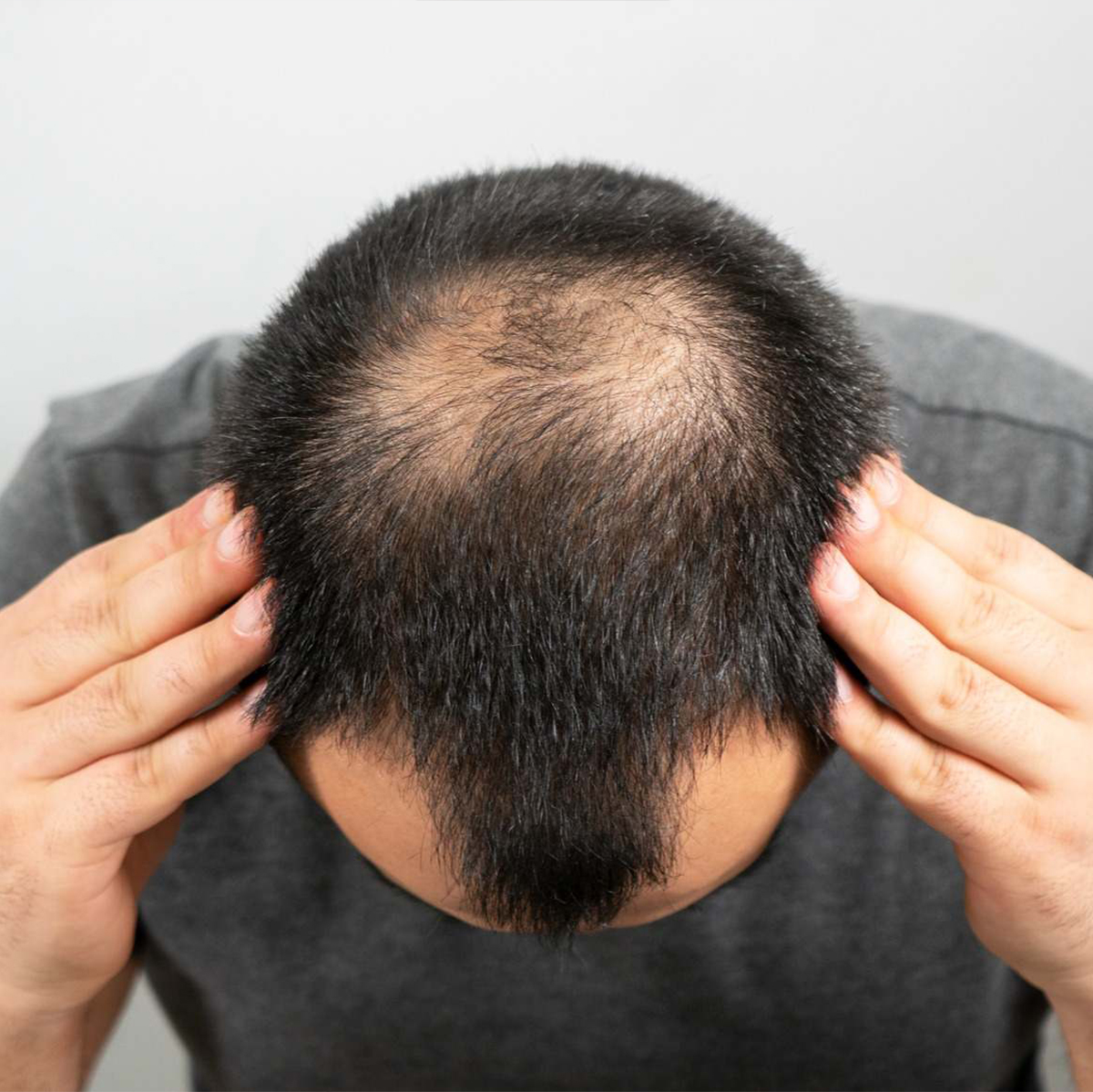 Alopecia Androgénica