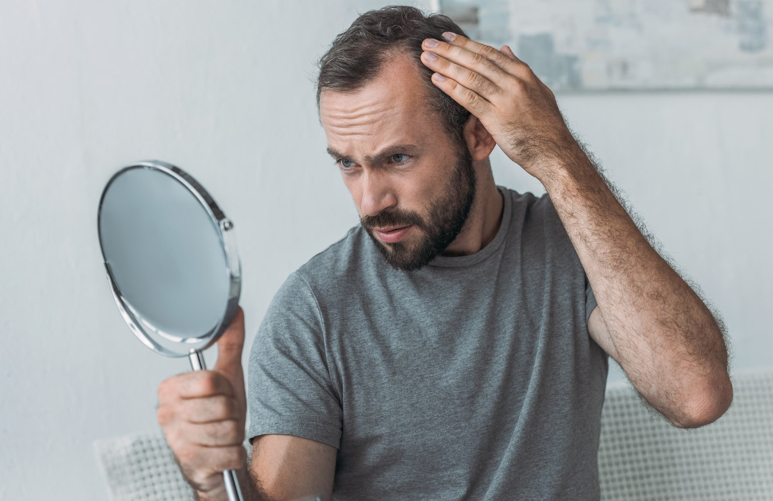 Alopecia Androgénica