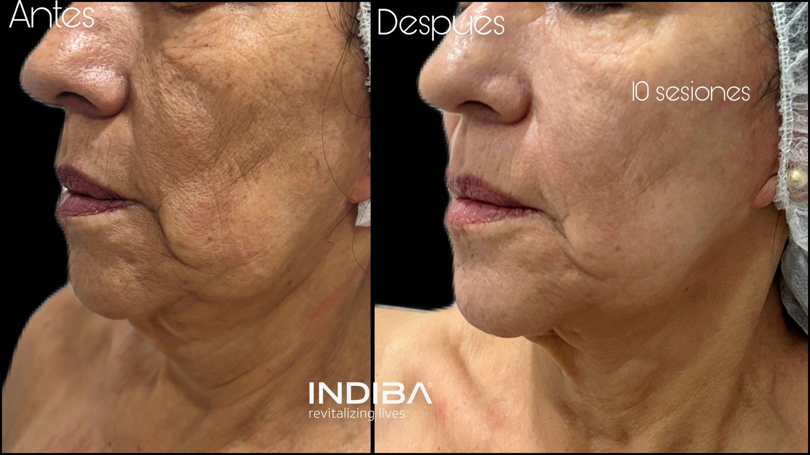 INDIBA®
