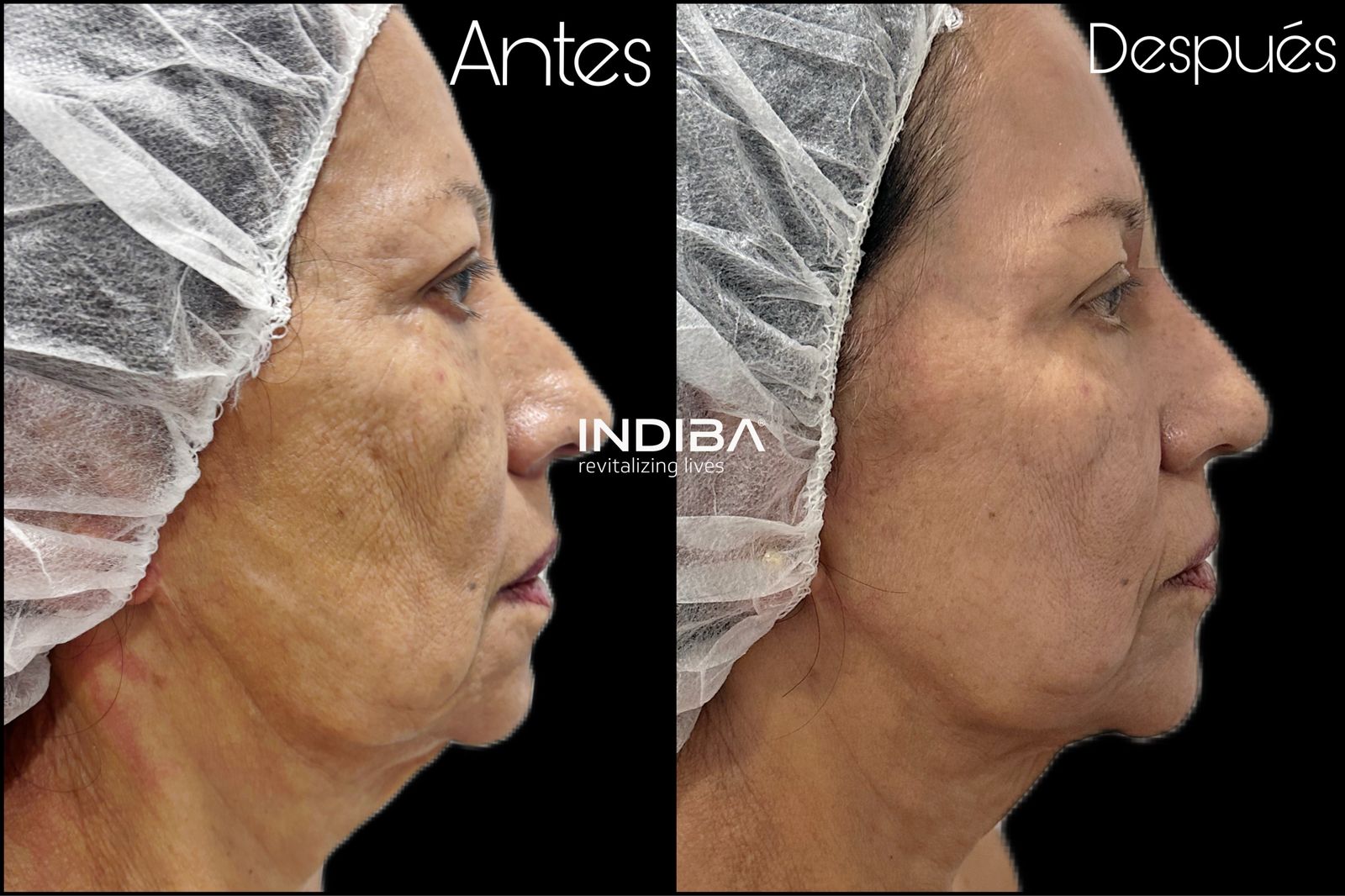 INDIBA®