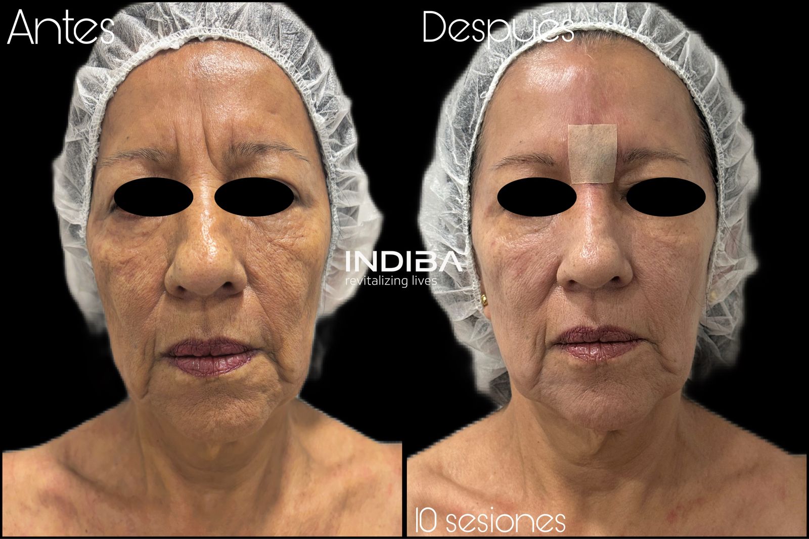 INDIBA®