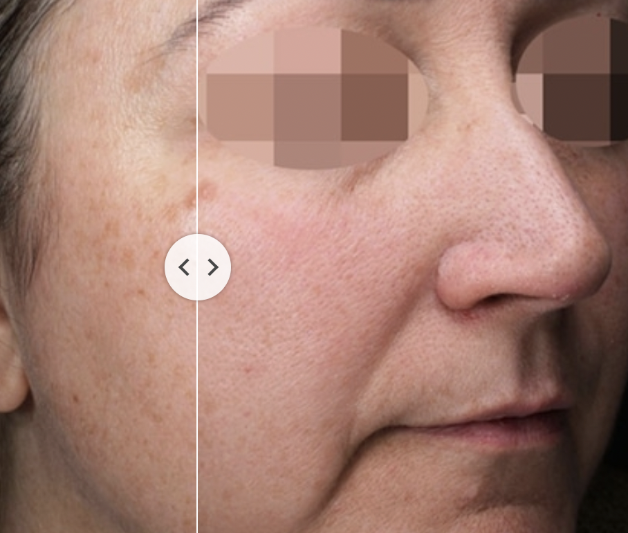 Láser Clearlift Q-Switch