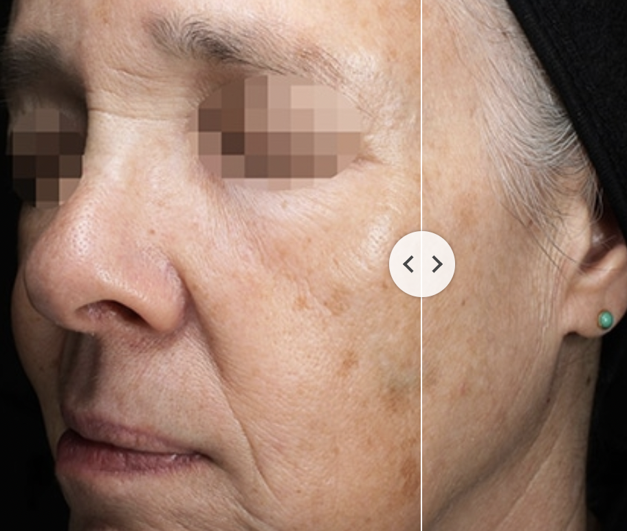 Láser Clearlift Q-Switch