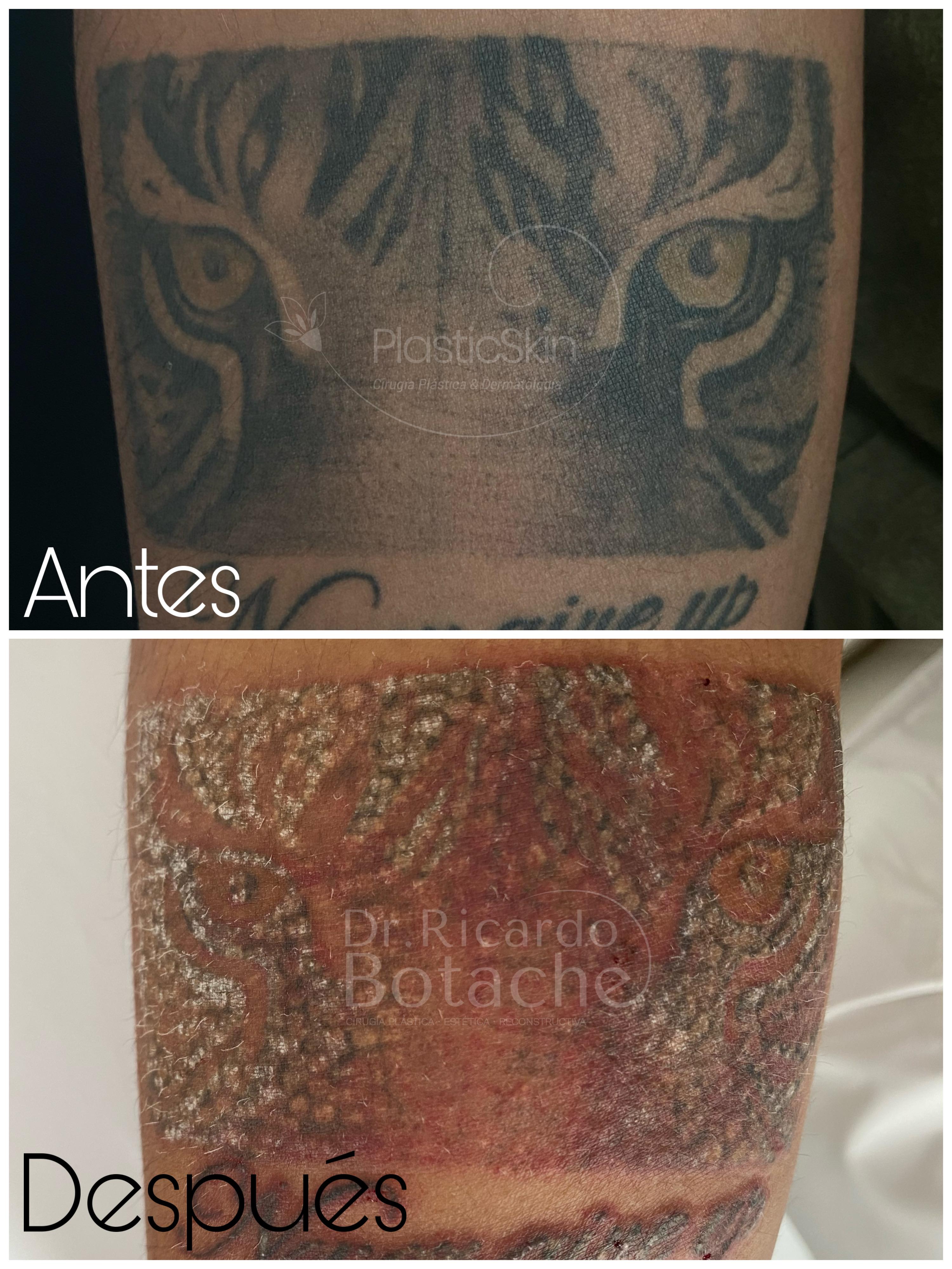 Tatuajes