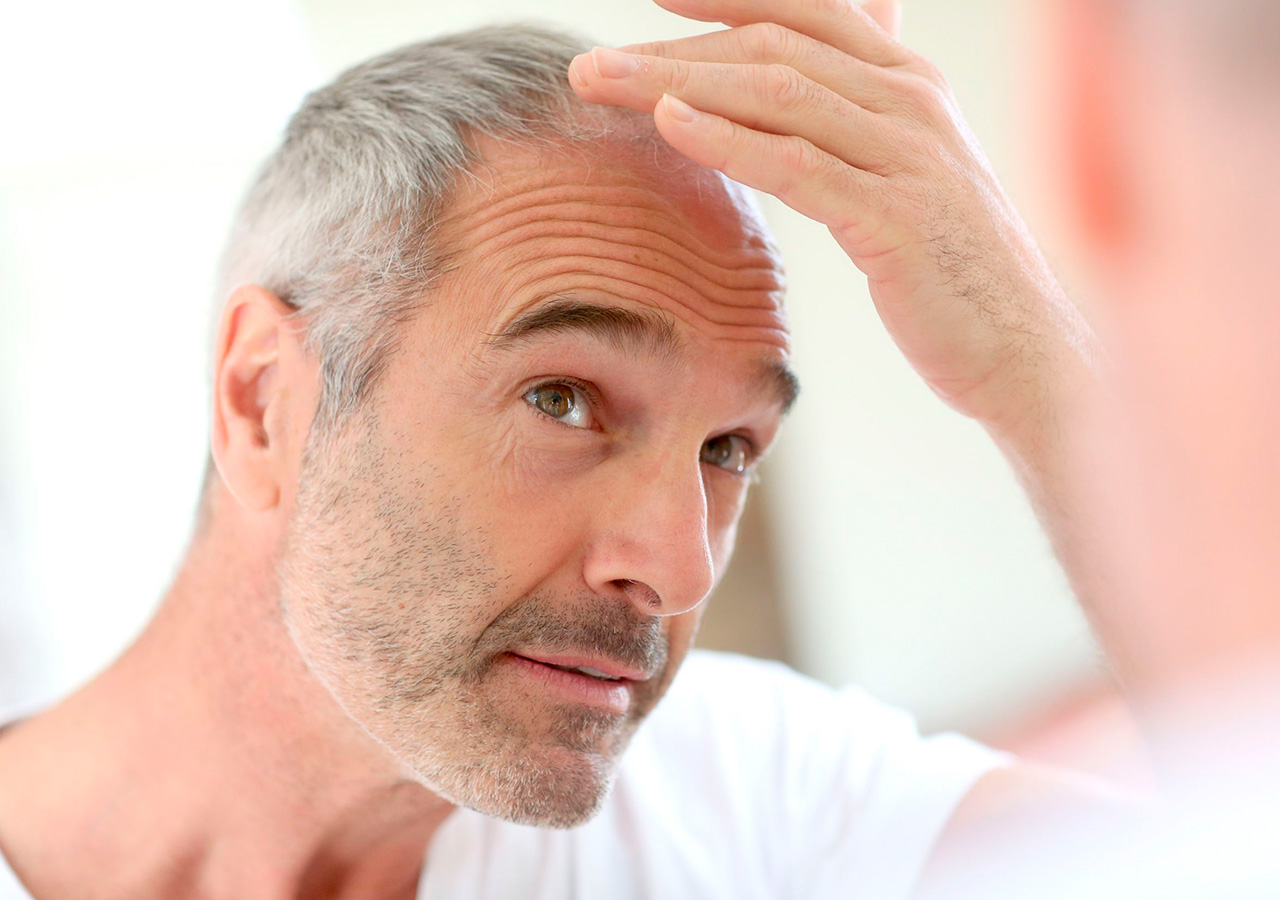 Alopecia