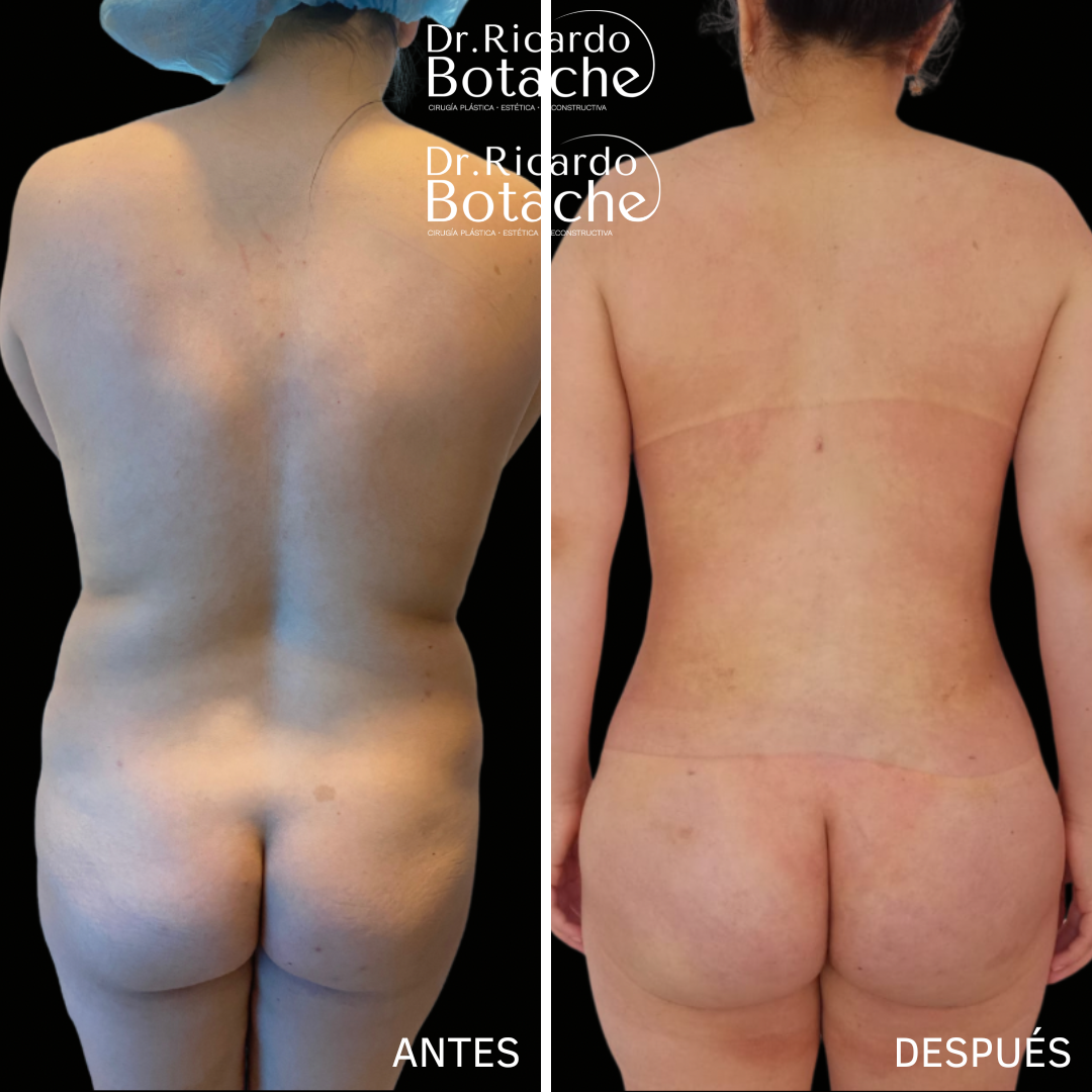 Antes y después de contorno abdominal