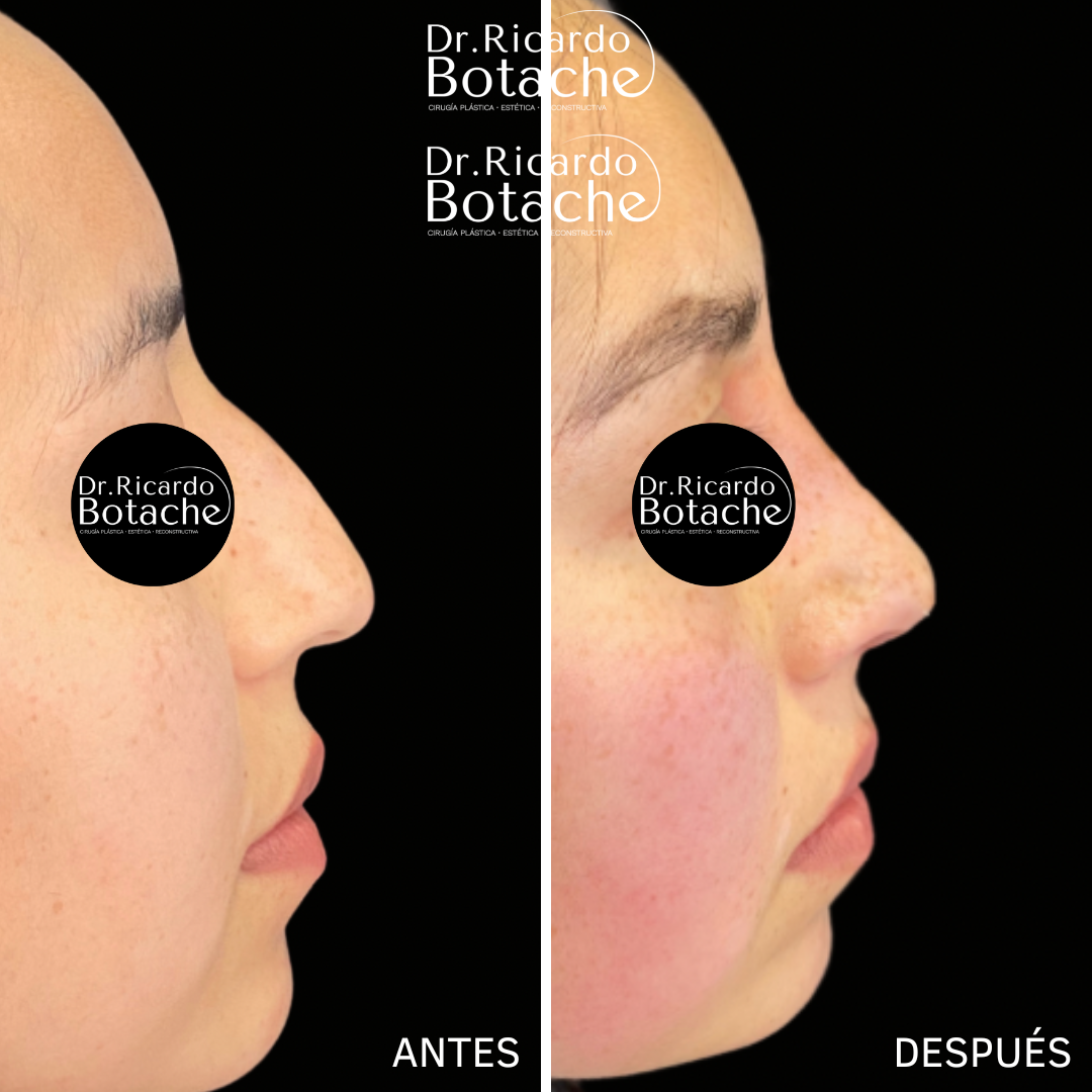 Resultado de rinoplastia