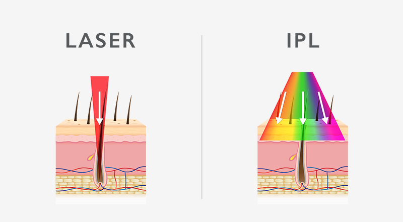 IPL Vs Laser