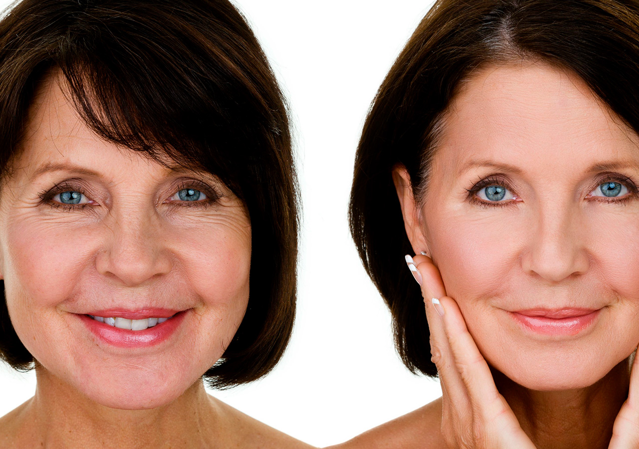 Radiesse Hidroxiapatita de calcio PlasticSkin
