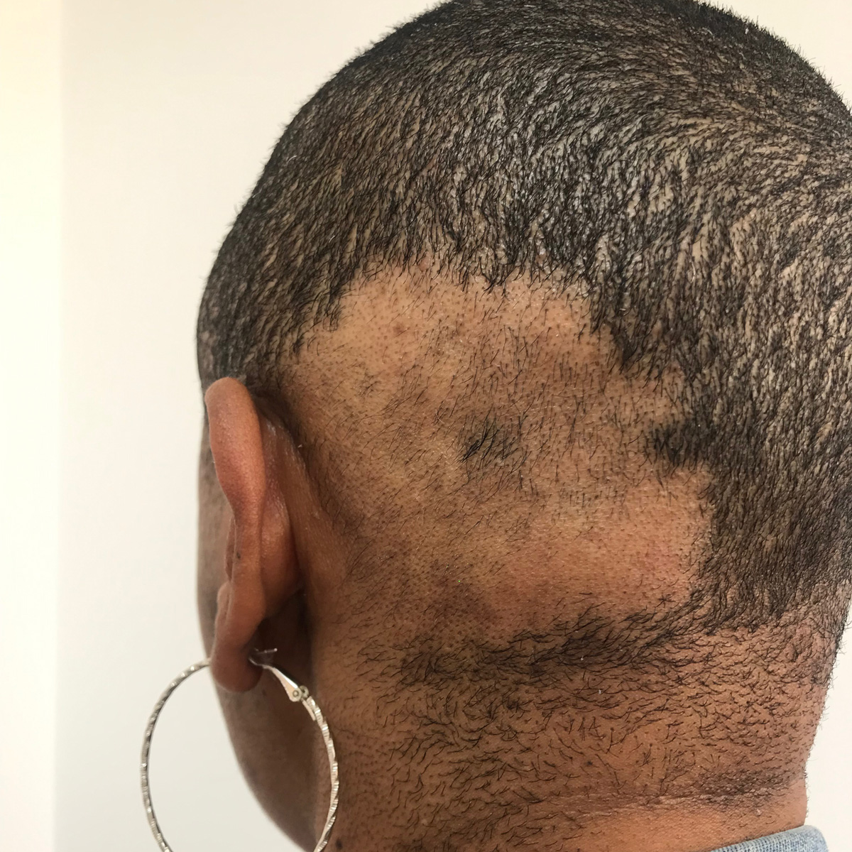 Alopecia