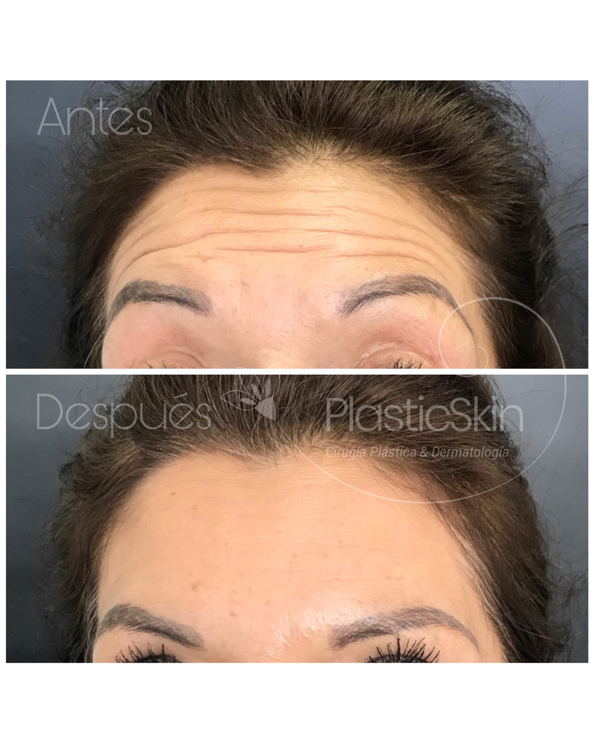 Botox