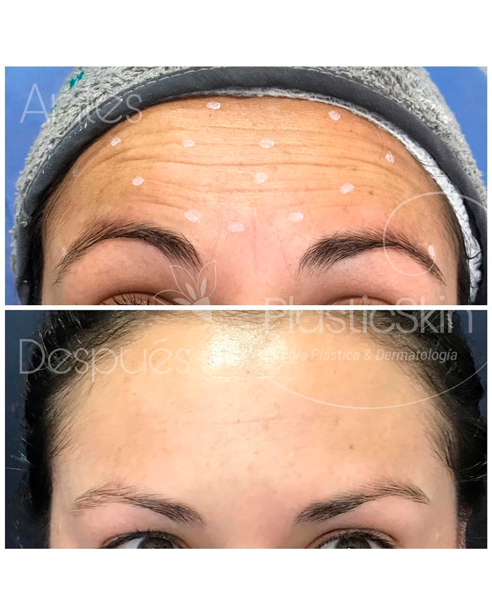 Botox