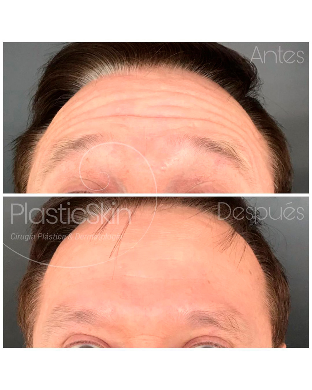 Botox