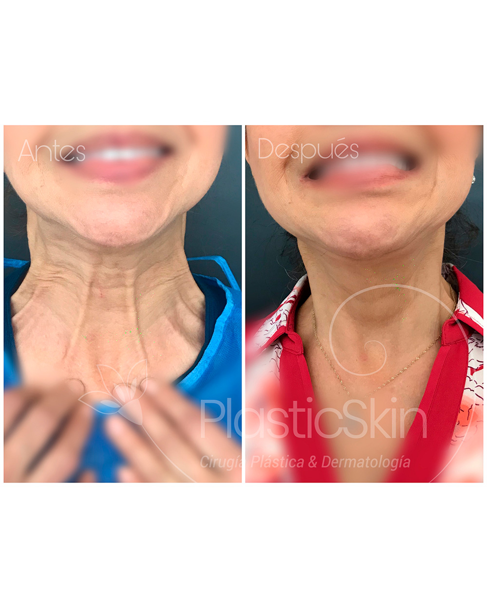 Botox