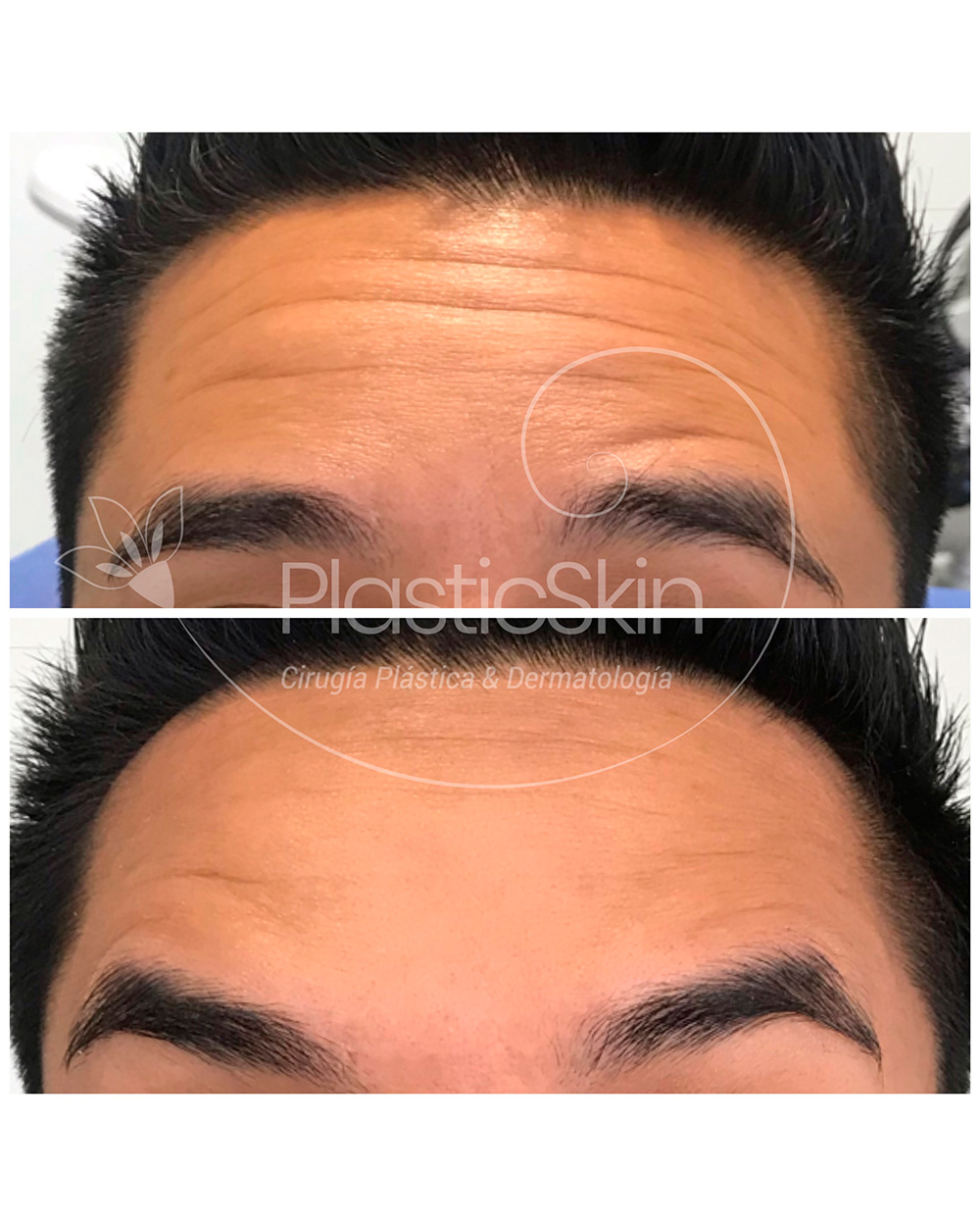 Botox