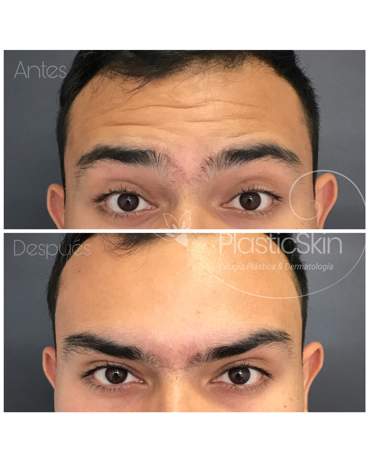 Botox