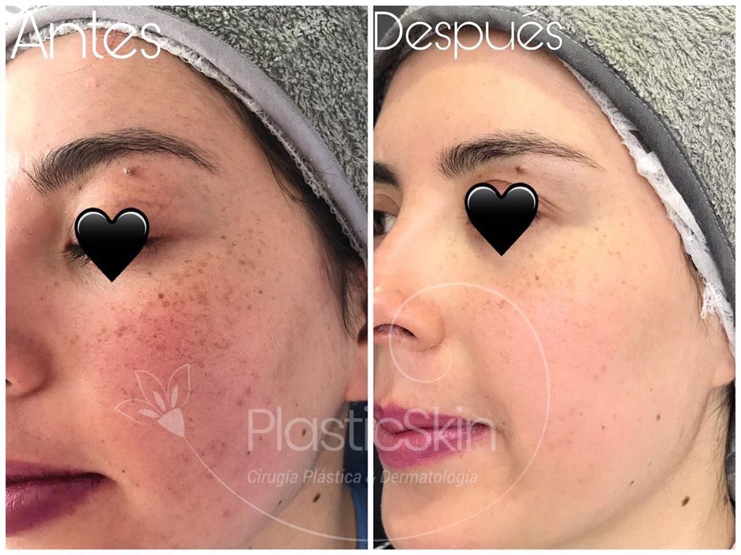 Dermapen