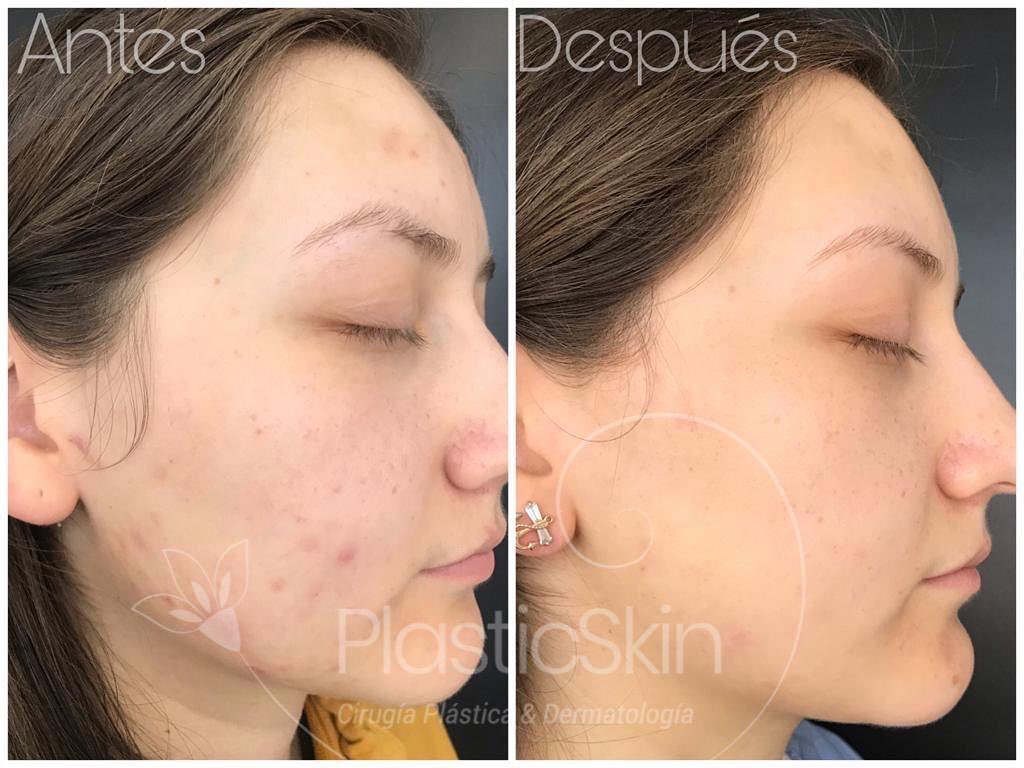 Dermapen