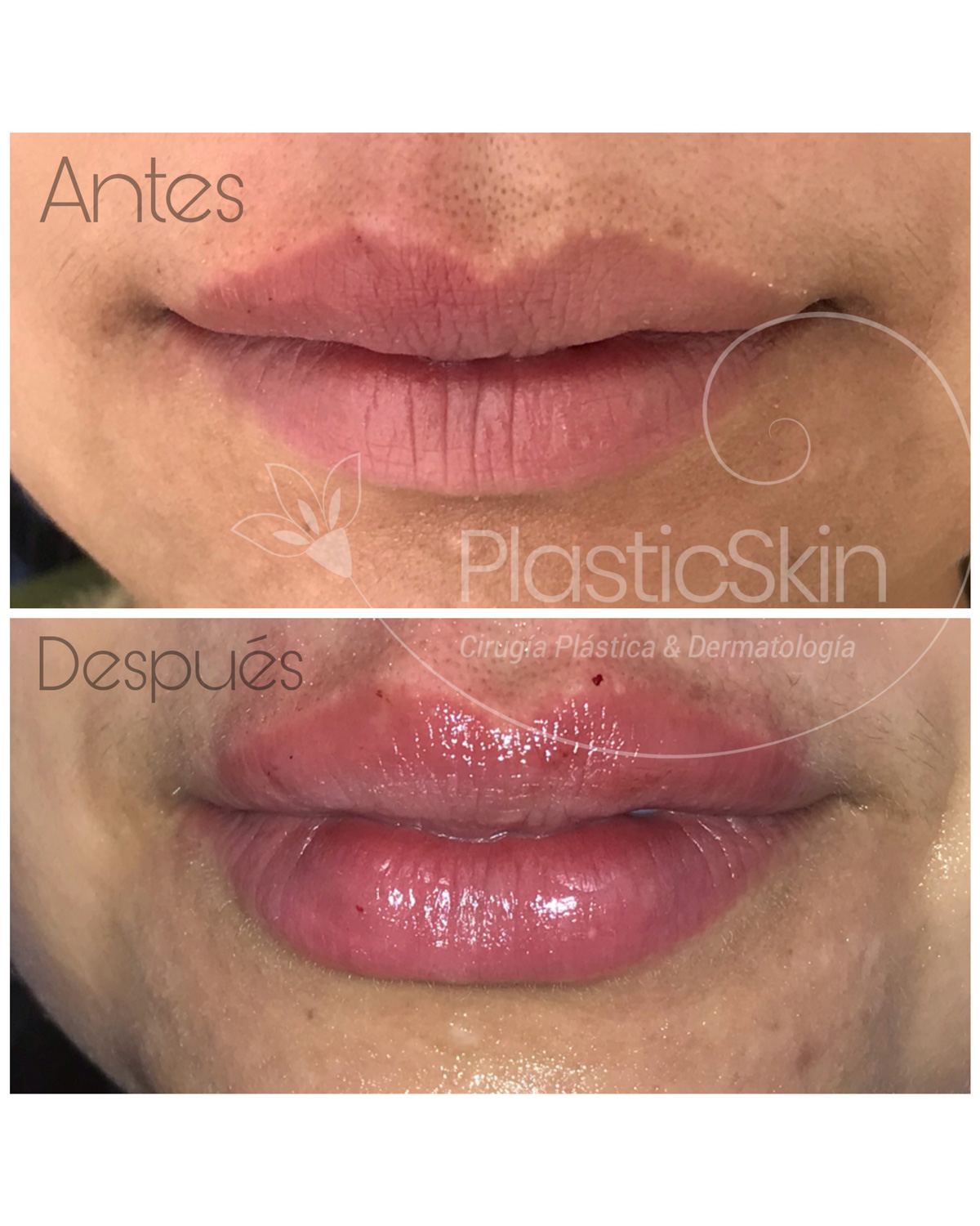Labios