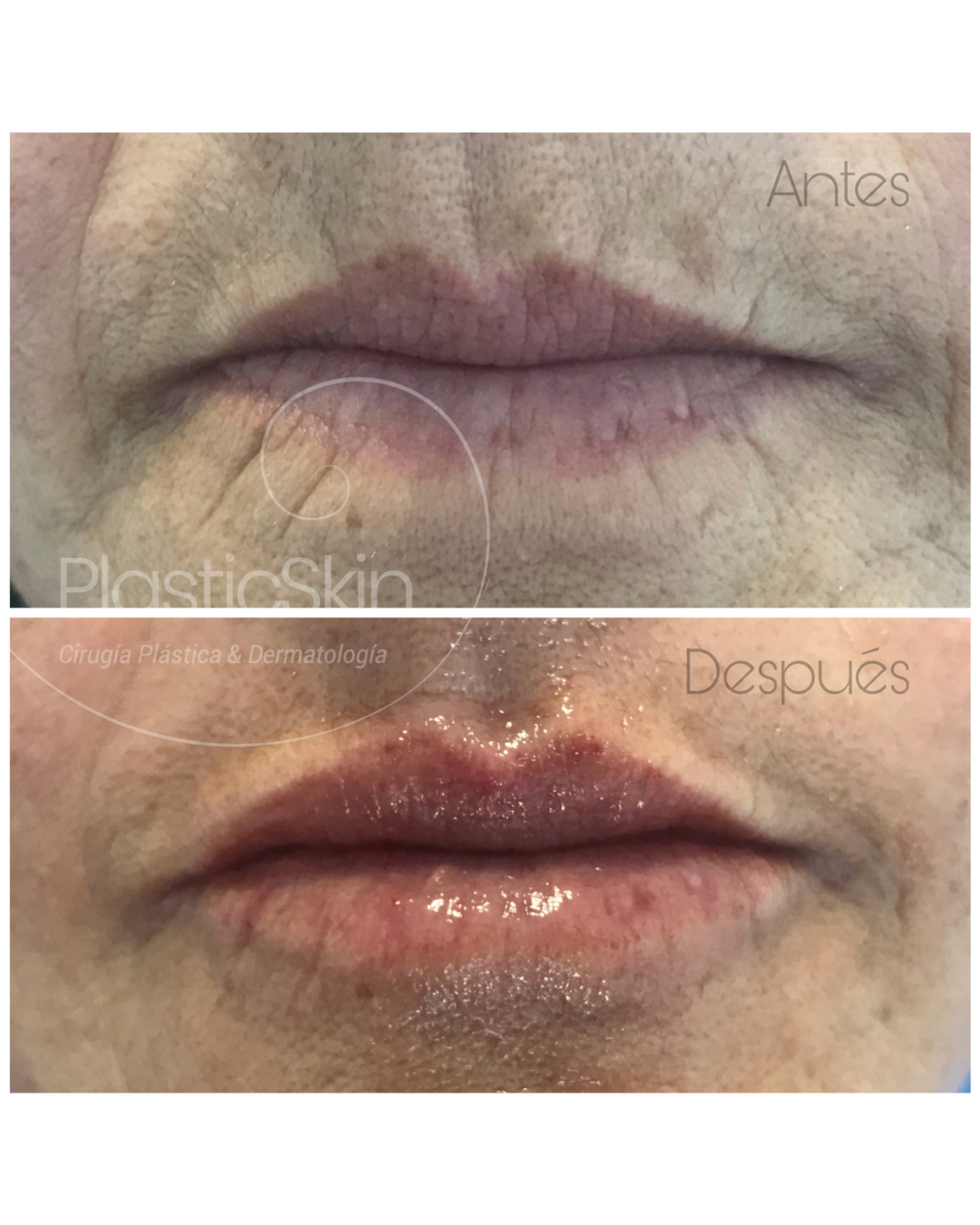 Labios