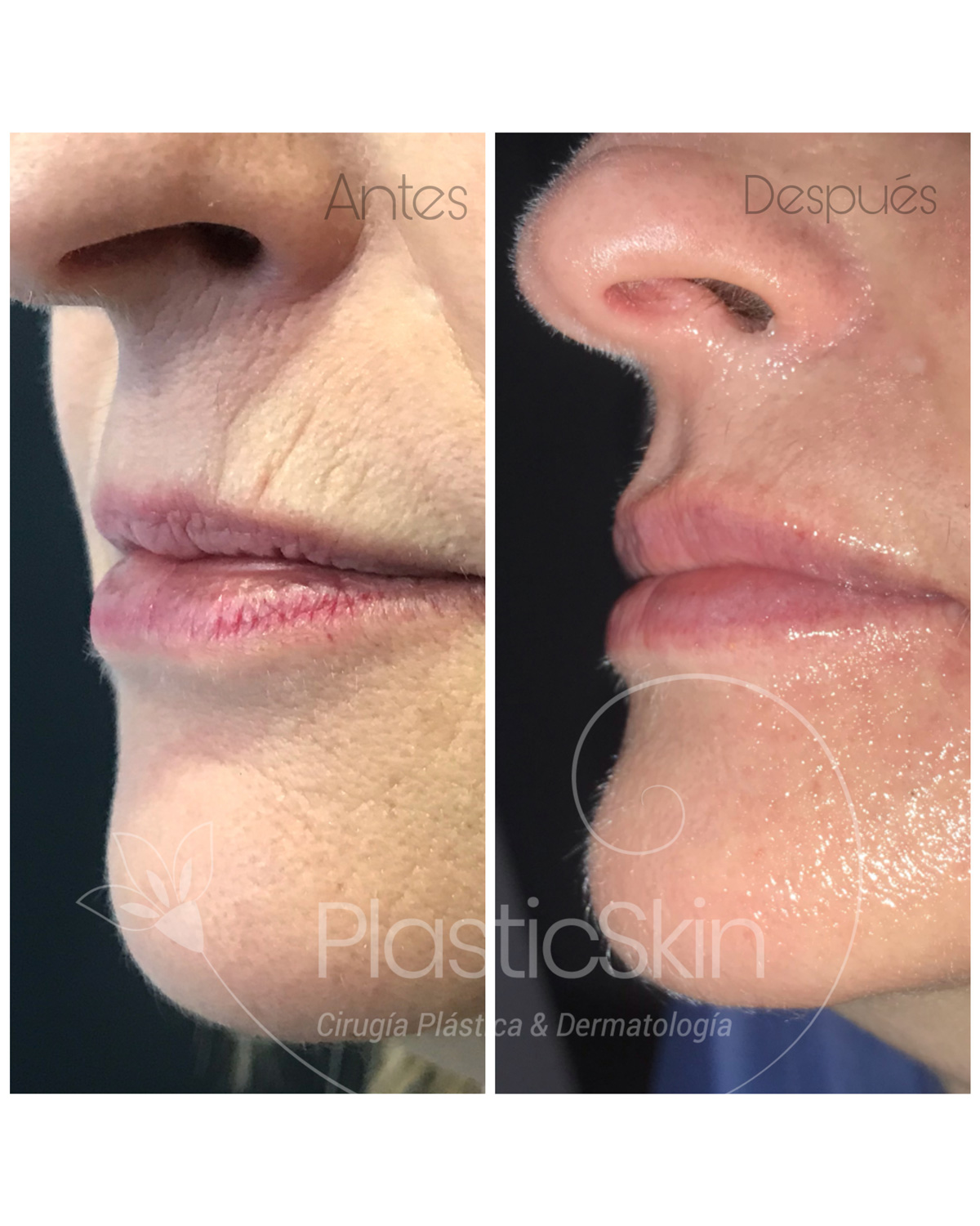 Labios