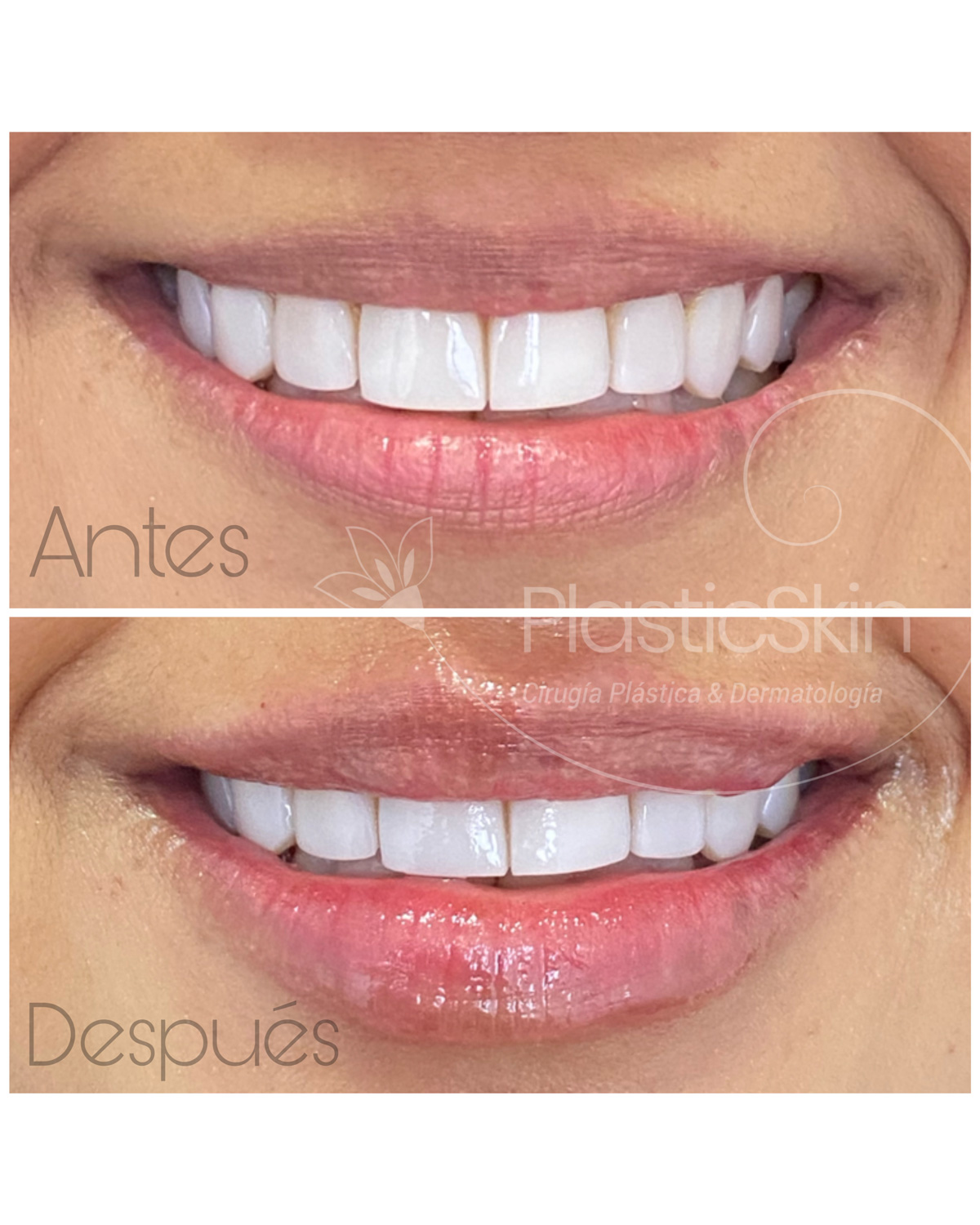 Labios