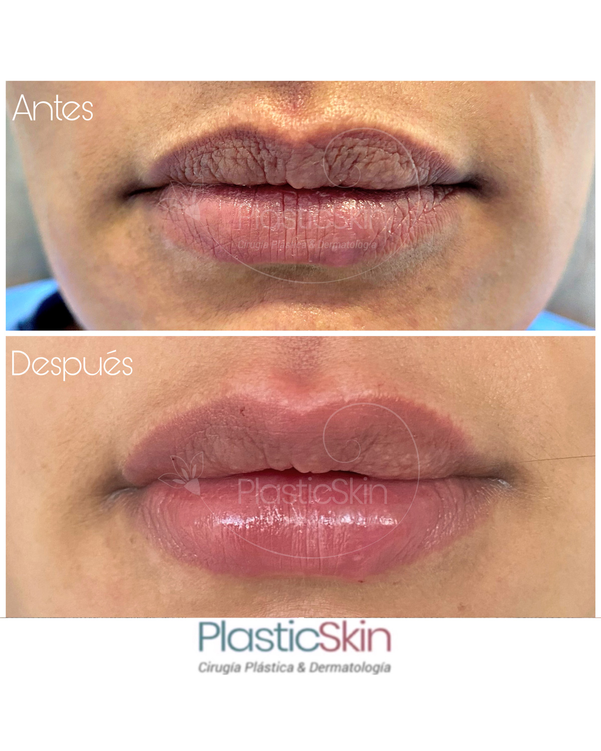 Labios