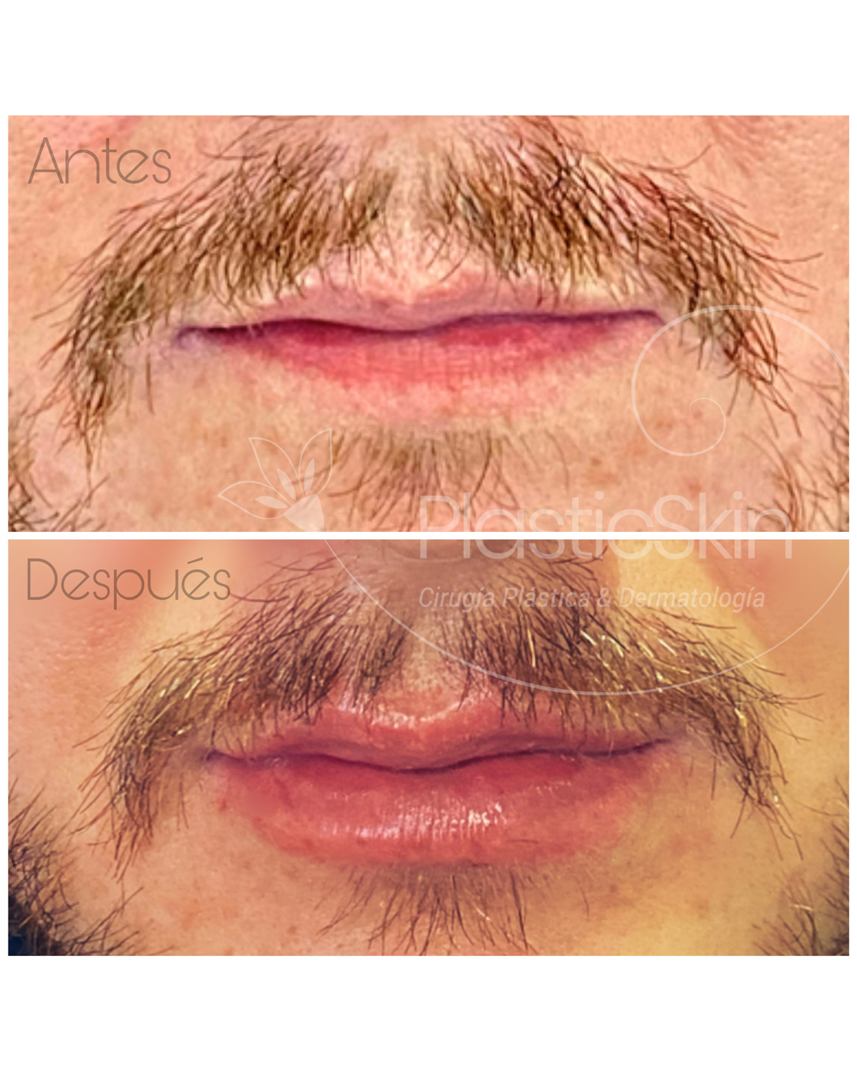 Labios