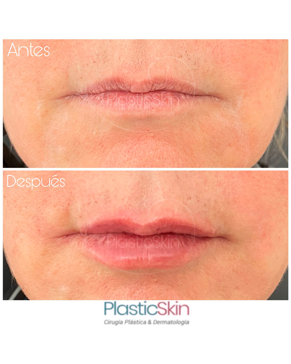 Labios