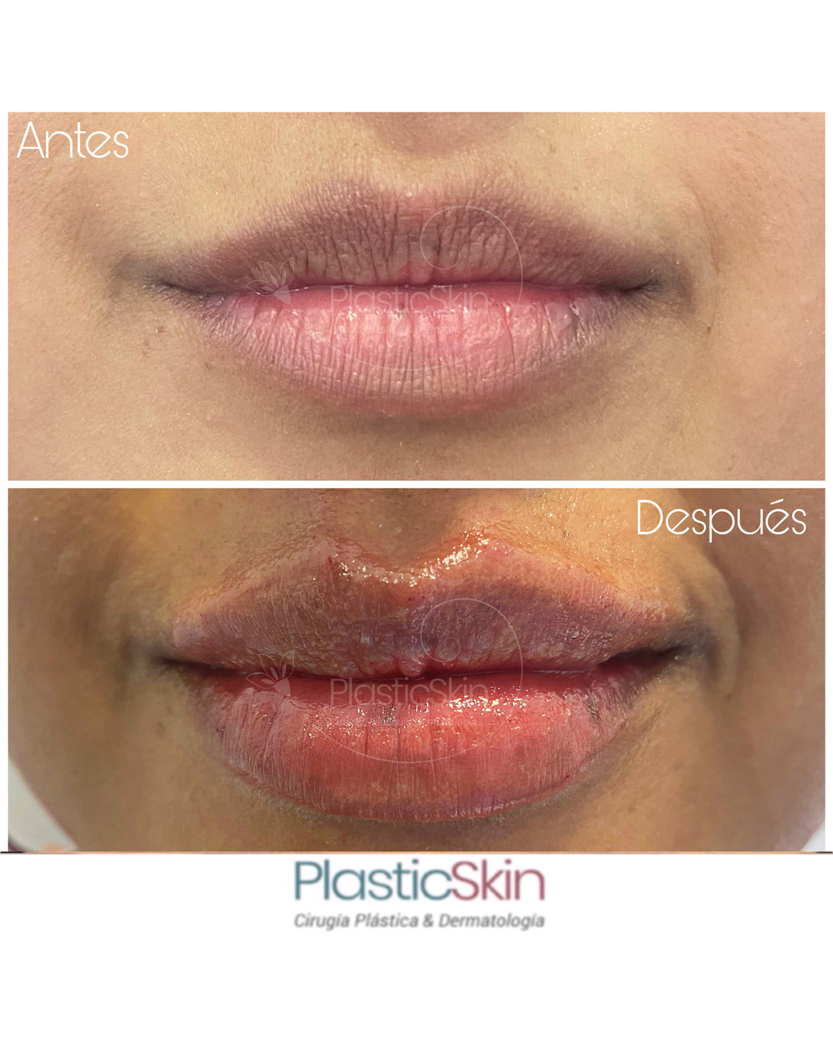 Labios