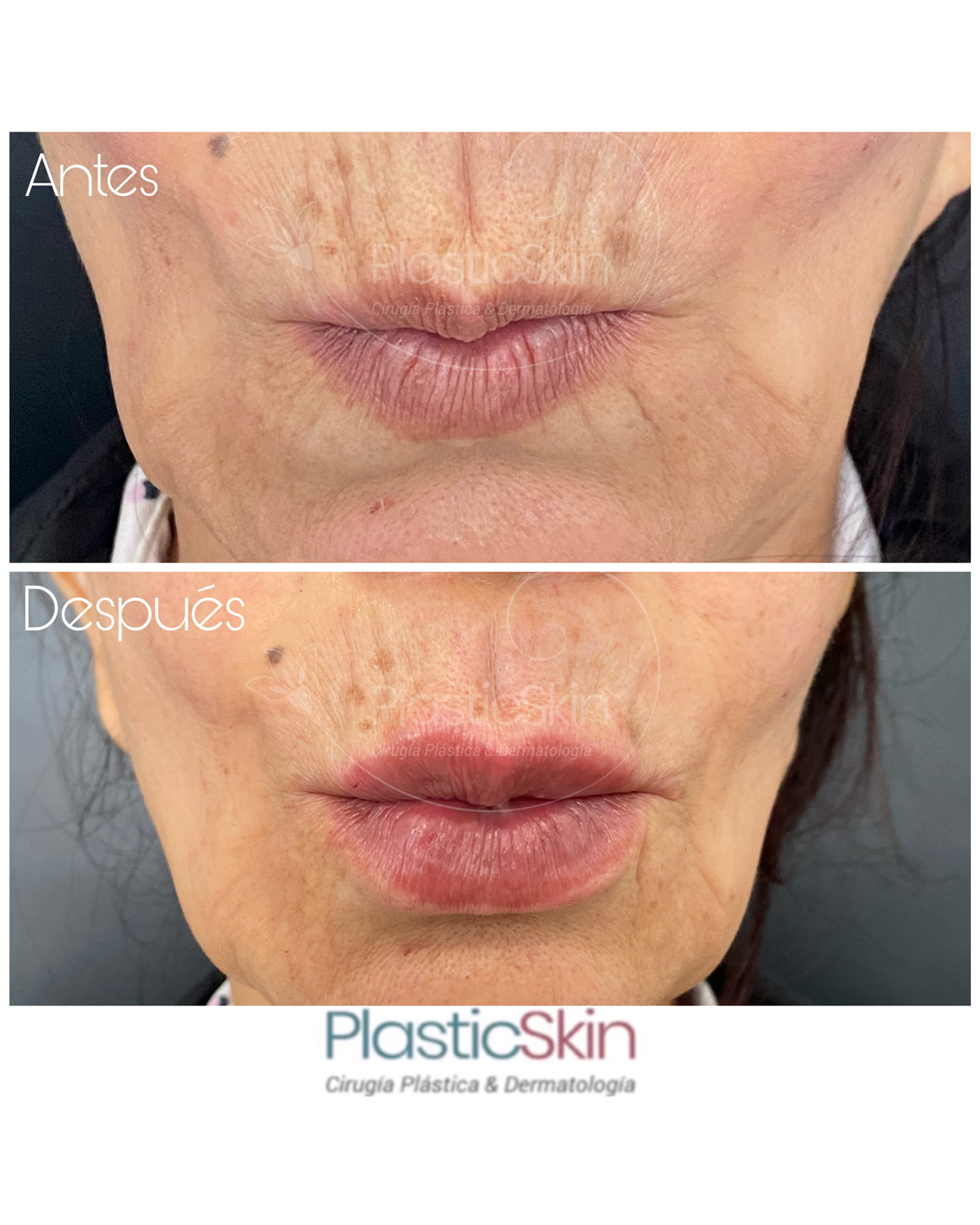 Labios