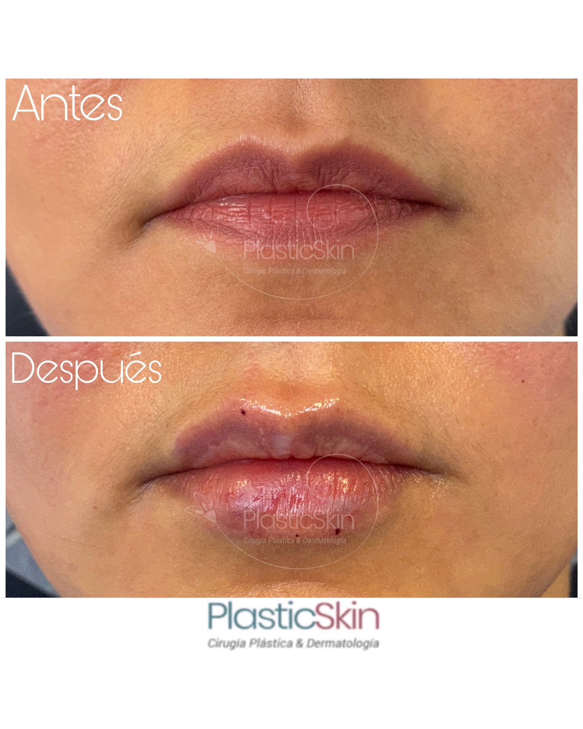Labios