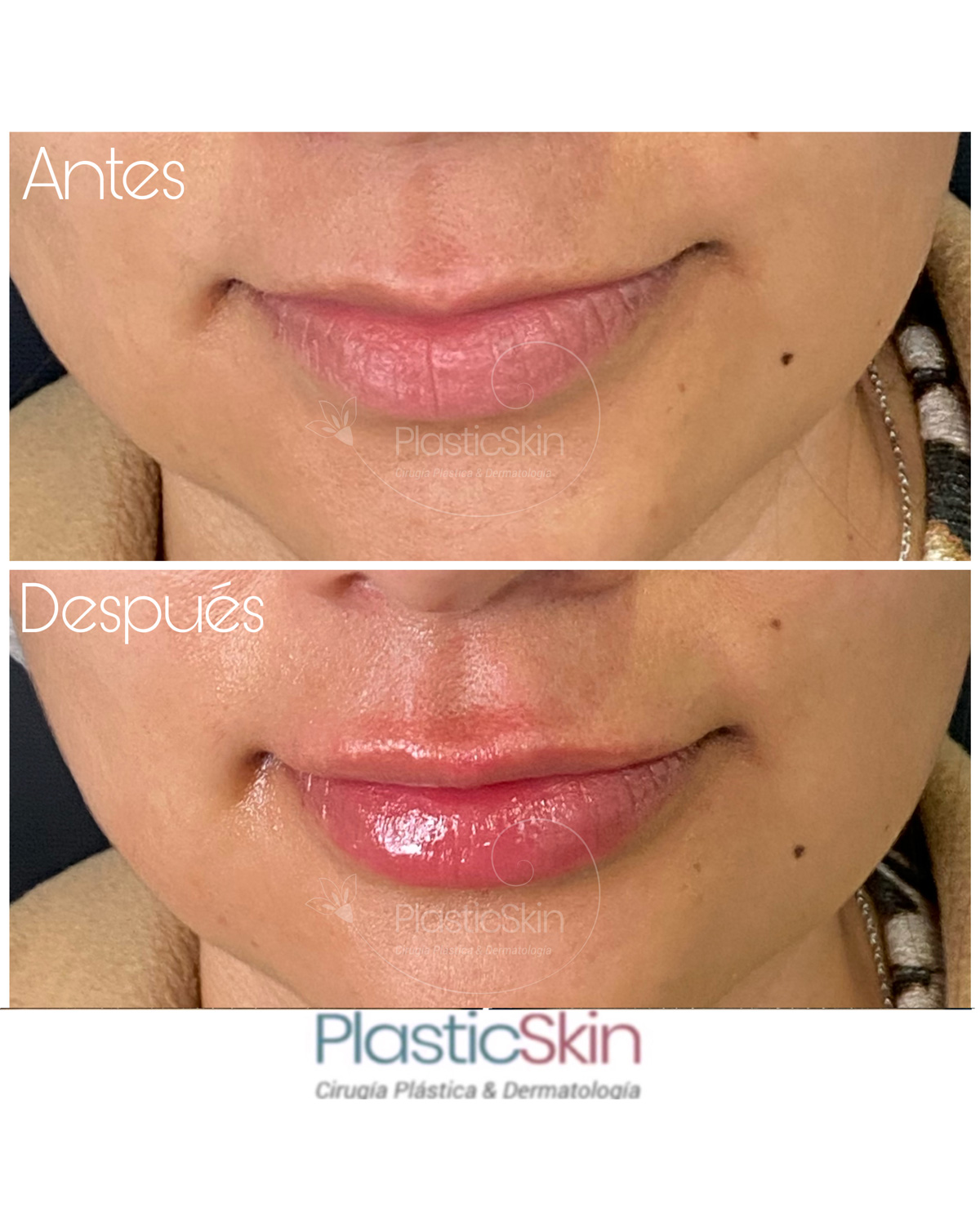 Labios