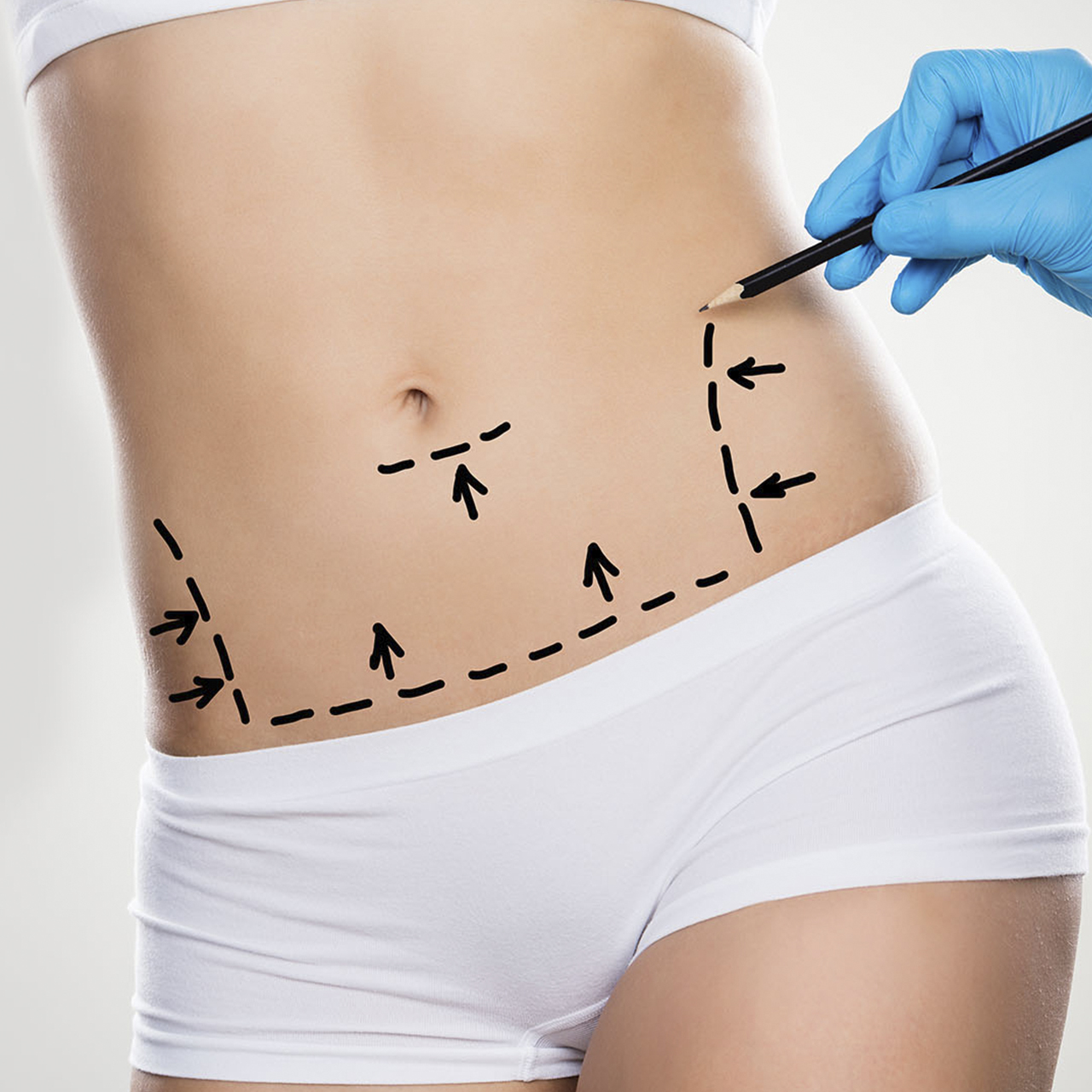 Lipoescultura