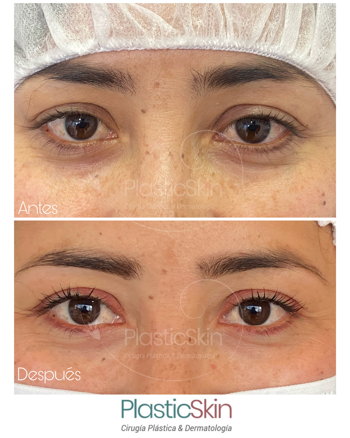Ojeras