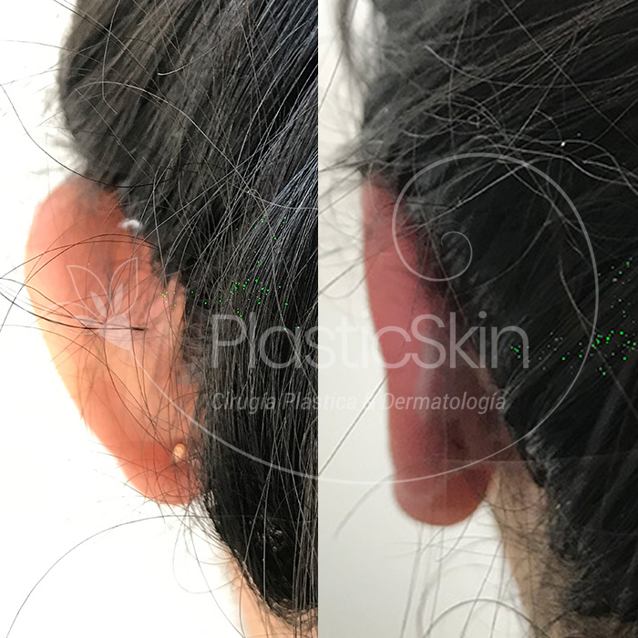 Otoplastia