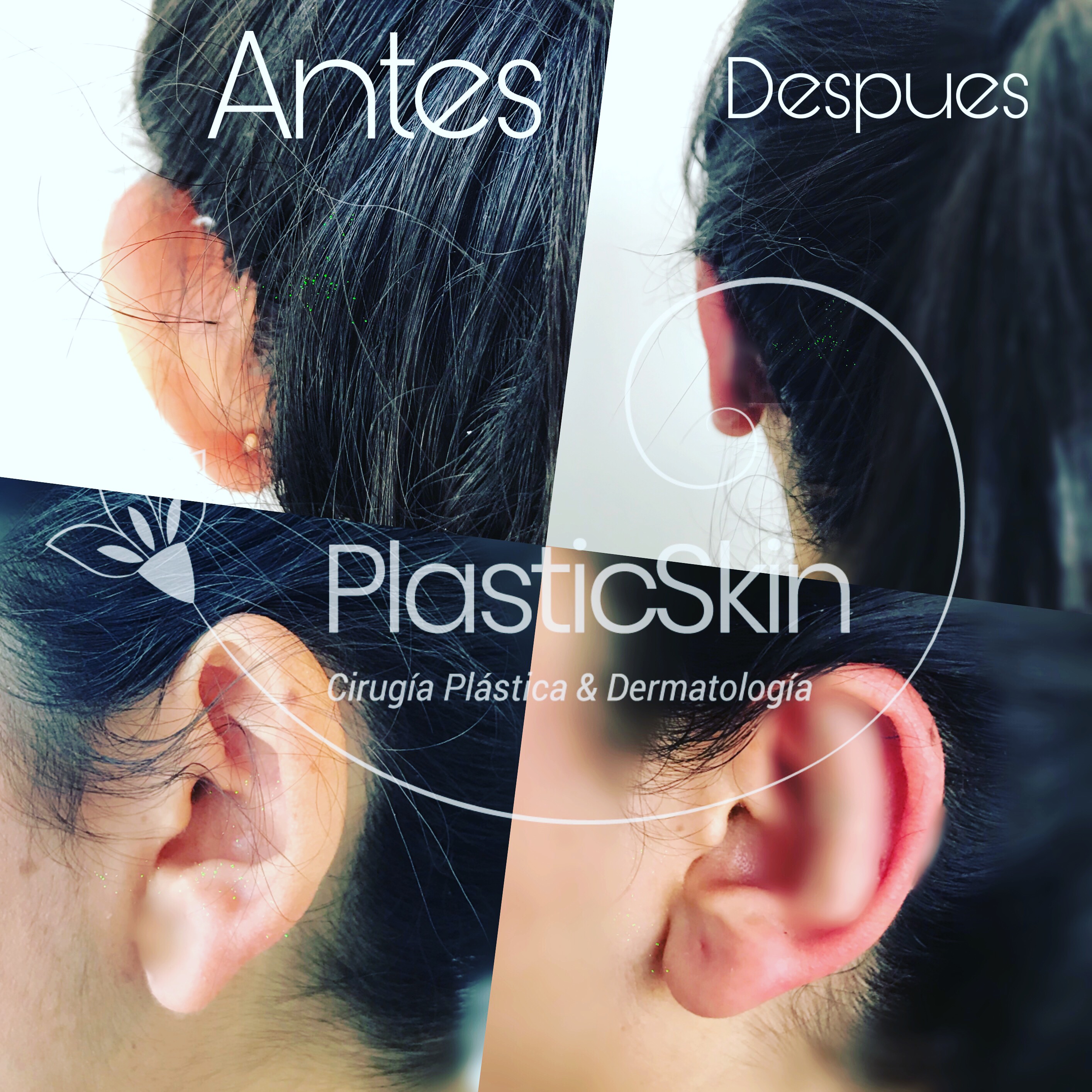 Otoplastia