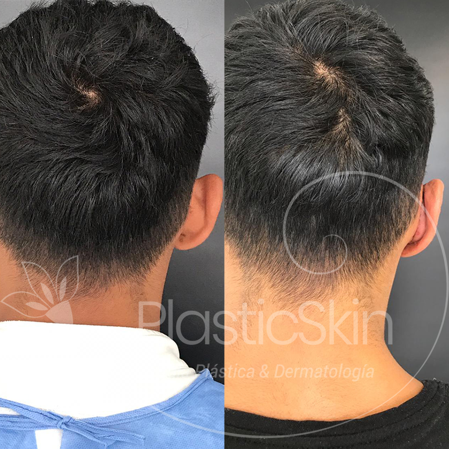 Otoplastia