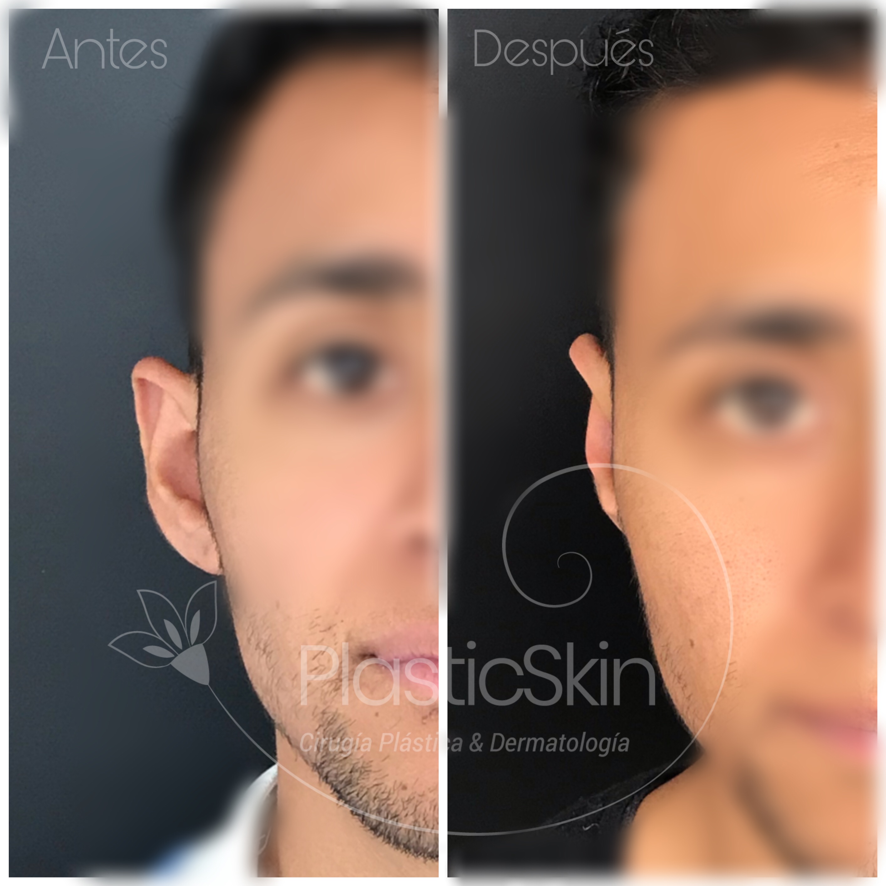Otoplastia