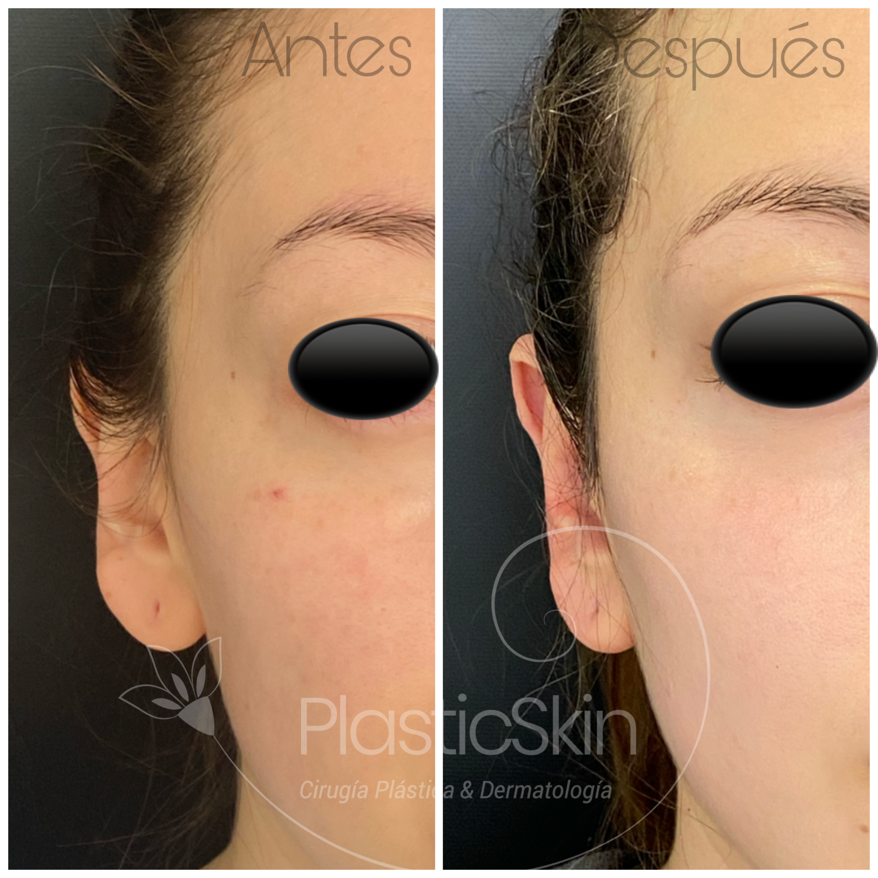 Otoplastia