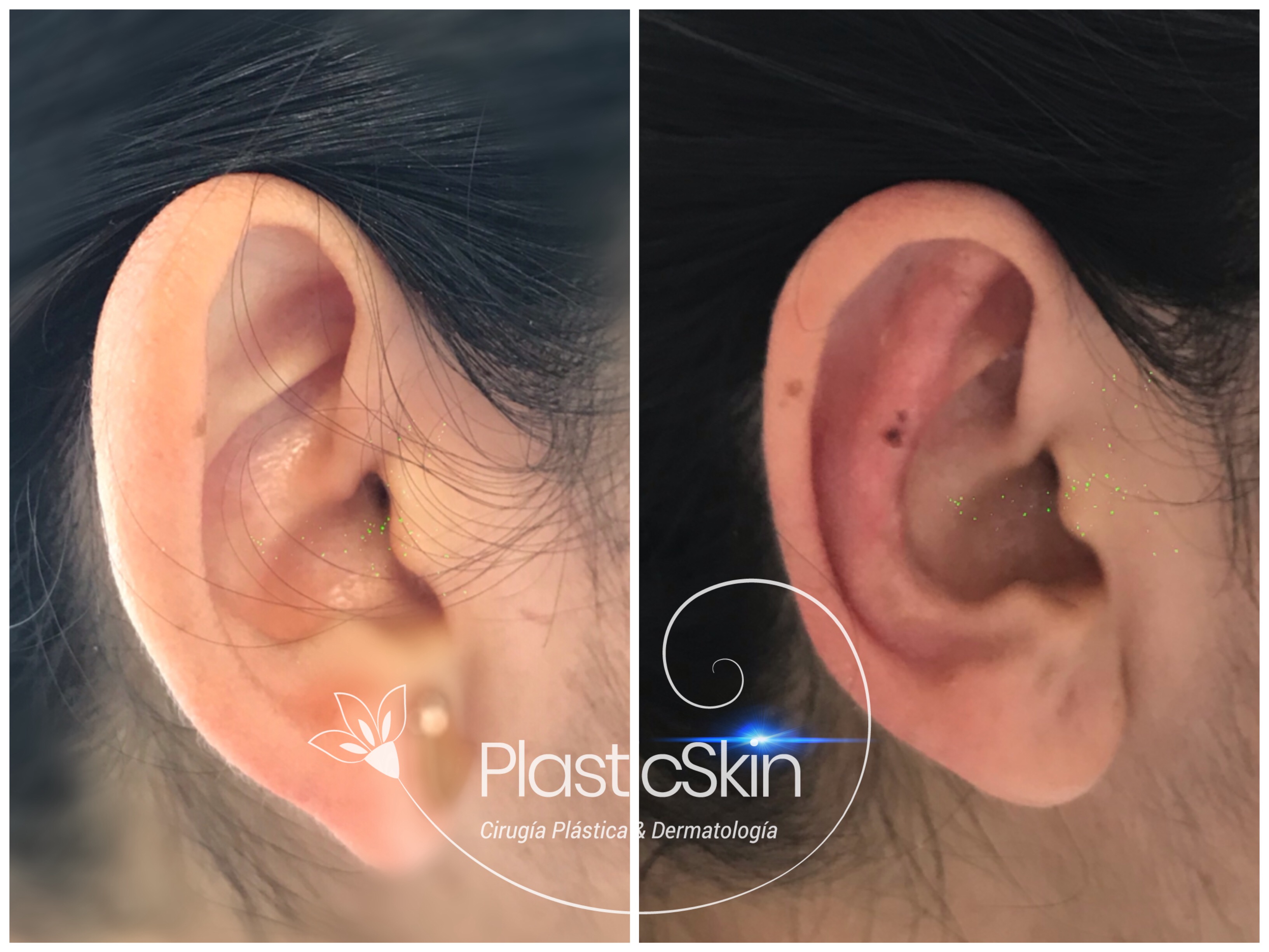 Otoplastia