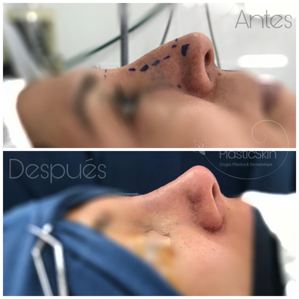 Rinoplastía