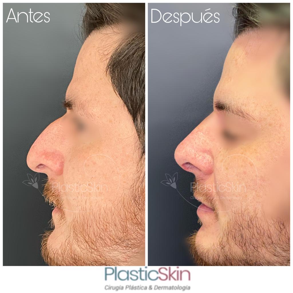 Rinoplastía