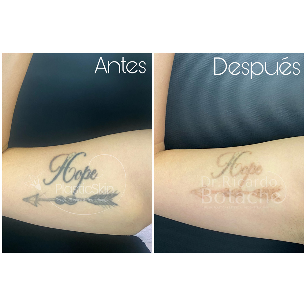 Tatuajes