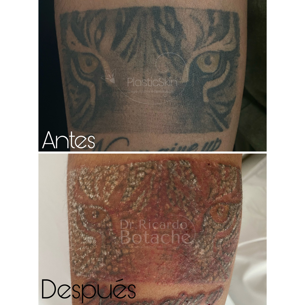 Tatuajes